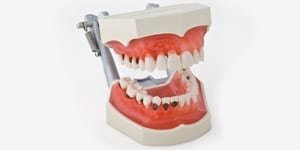 P2D-001 Parodontiemodell mit Karies OK + UK