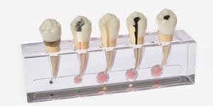 P23-END.2 Endodontiemodell “Granulom”