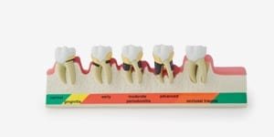 P23-PD1 Demonstrationsmodell Parodontose-Stadien