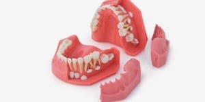 P1-600B Wachstumsmodell 5/9 Jahre (OK + UK)