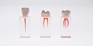 S3-U1 Pulpa-Kav.-Modell einzeln, Schneidezahn