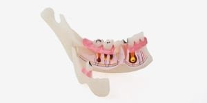 P13-TR10 Pathologisches, halbes UK-Modell